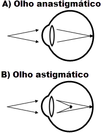 Olho normal versus olho astigmático